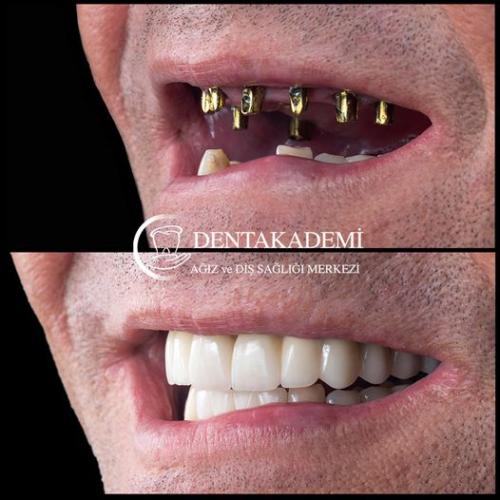 ALL ON 6 Before / After photo